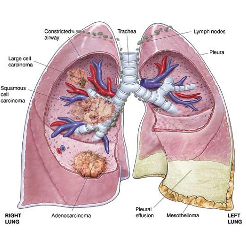 Asbestos Cancer & Mesothelioma in Lungs | Mesothelioma Treatment
